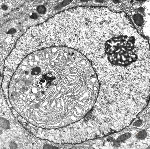 F,61y. | intranuclear cytoplasmic inclusion - giant cell hepatitis F,61y. | intranuclear cytoplasmic inclusion - giant cell hepatitis